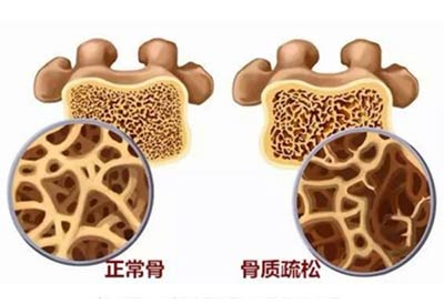 便携式骨密度检测仪品牌介绍骨密度高了低了都不好人体峰值骨量多少岁蕞佳？